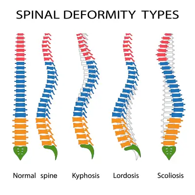 Treating Spinal Curvature Deformities with Chiropractic BioPhysics
